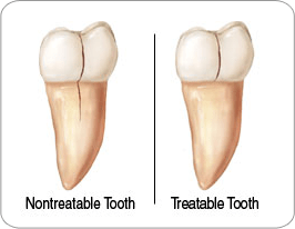 Cracked Tooth