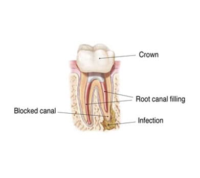 Blocked Canal and Infection