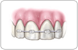 Avulsed Teeth Treatment